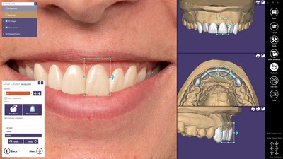 exocad ChairsideCAD is an open and device and manufacturer-neutral CAD/CAM software for clinical environments. With the new add-on module Smile Creator, now available with ChairsideCAD 2.3 Matera, highly aesthetic restorations can be virtually planned simply, quickly and predictably by combining patient photos and 3D situations.