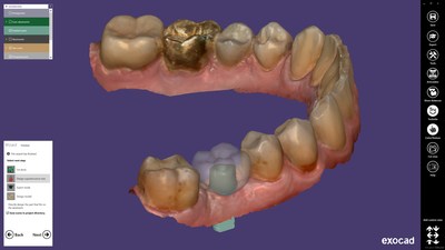 With the new ChairsideCAD 2.3 Matera modules, the software can intelligently expand the individual practice’s offerings. With the new Implant Module, abutments and screw-retained crowns as well as bridges can be designed quickly and easily.